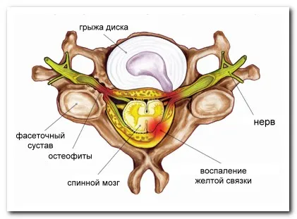 як лікувати радикуліт шиї