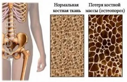 як лікувати остеопороз рук