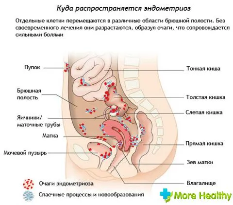 Ендометріоз 1 ступеня діагностика та хвороби