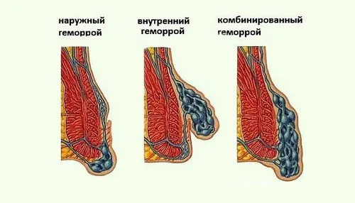 народні засоби