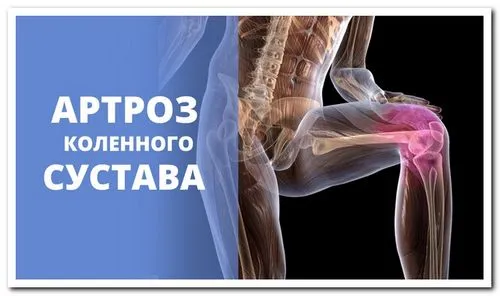вилікувати артроз колінного суглоба