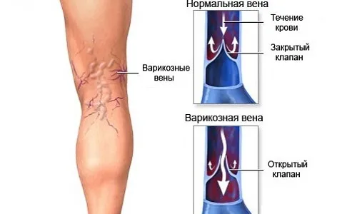 вилікувати артроз будинку