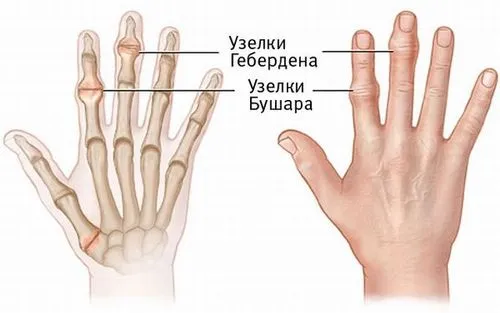 деформуючий остеоартроз кистей рук лікування