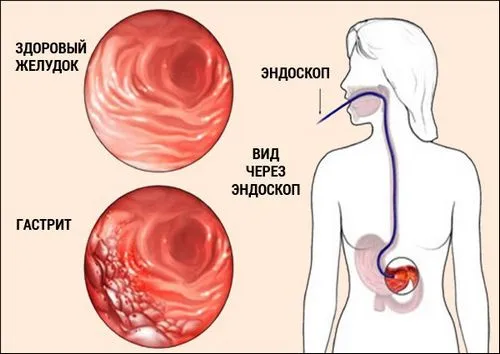 як лікувати гастрит шлунка в домашніх умовах