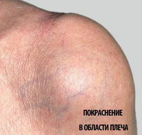 вапняний кам'яний бурсит плечового суглоба лікування симптоми
