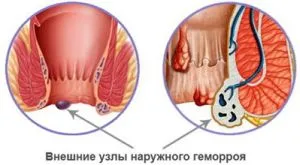 безопераційне лікування геморою