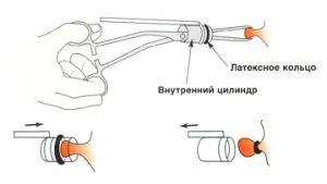 геморой 3 ступеня лікування без операції