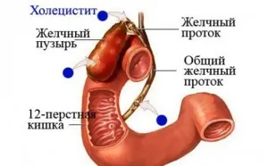 ніж лікувати холецистит