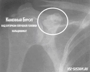 як лікувати бурсит плечового суглоба