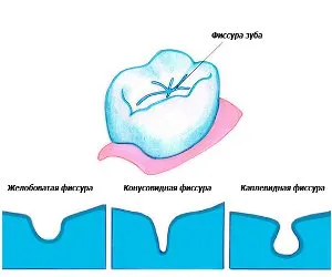 вилікувати карієс самостійно