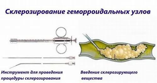 лікування геморою без операції