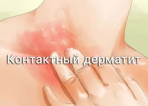 ніж лікувати контактний дерматит при вагітності