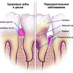 як лікувати ясна від пародонтозу