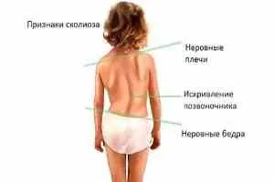 як лікувати остеохондроз у дітей