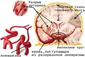 лікуватися чи інсульт