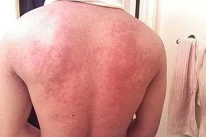 лікувати пігментну кропив'янку