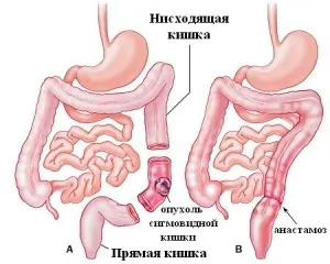 Пухлина сигмовидної кишки: симптоми, які сигналізують про небезпеку! як лікувати рак сигмовидної кишки