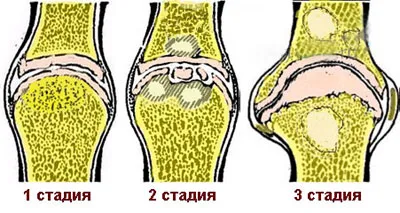як лікувати остеохондроз 3 ступеня