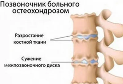 як лікувати остеохондроз 3 ступеня