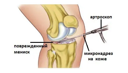 розрив медіального меніска колінного суглоба