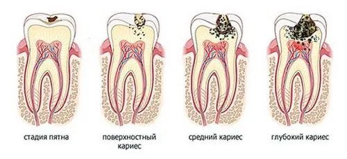 Гострий карієс гострий карієс