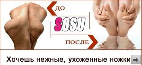 як лікувати натоптиші на п'ятах