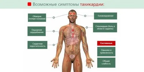 пароксизмальна надшлуночкова тахікардія ЕКГ ознаки