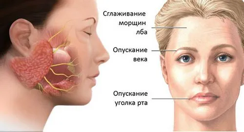 як лікувати невроз лицьового нерва