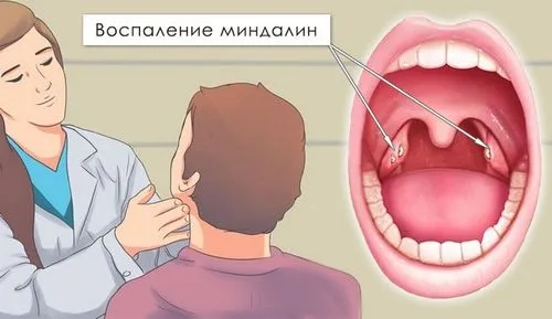 як лікувати ангіну і отит