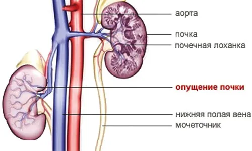 Опущення нирки: що робити і які є способи лікування як лікувати опущення нирки