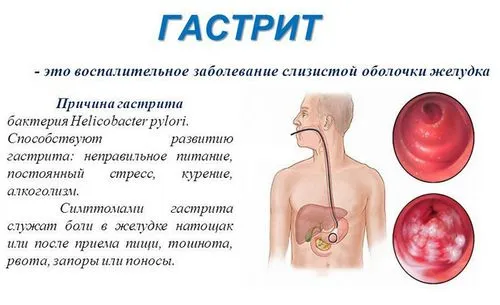 як лікувати гастрит загострення