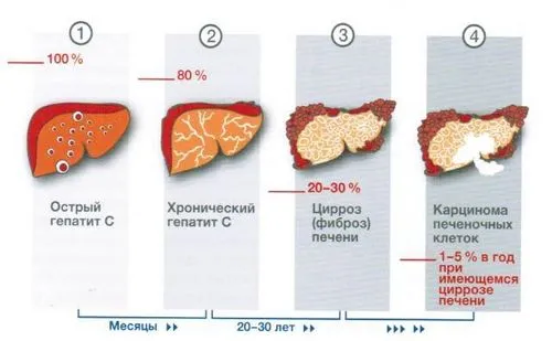 гепатит а лікується