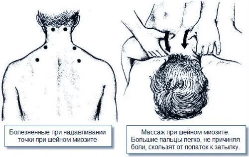 як лікувати міозит шиї будинку