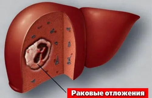 лікування