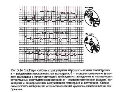 пароксизмальна надшлуночкова тахікардія ЕКГ ознаки