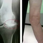 лікувати болять суглоби