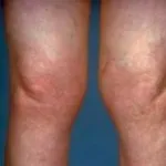 як лікувати ревматизм колін