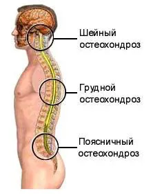 як лікувати корінцевий хондроз
