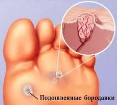 як лікувати бородавку Суперчістотел