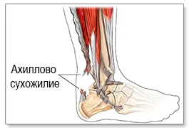 розрив ахіллового сухожилля