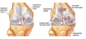 як лікувати псоріаз суглобів
