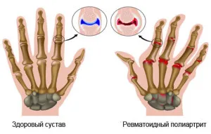 як лікувати ревматизм ніг у дітей