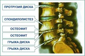 як вилікувати артроз шиї