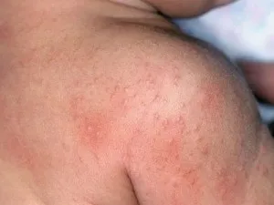 як лікувати атиповий псоріаз