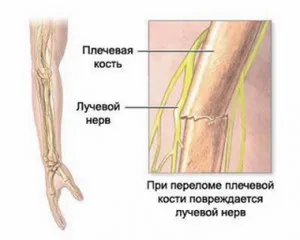 як лікувати забій ліктьового нерва