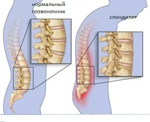 як лікувати псоріаз суглобів
