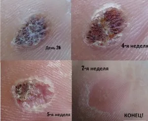 як лікувати бородавку Суперчістотел