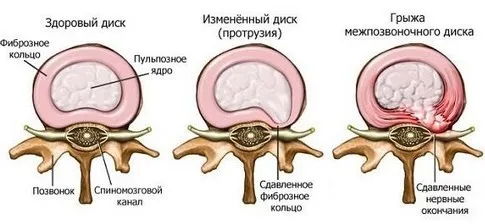 як лікувати шийно грудний радикуліт