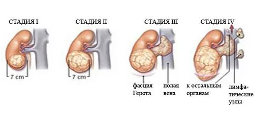 як лікувати рак нирок