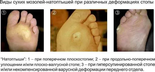 як лікувати мозоль на ступні